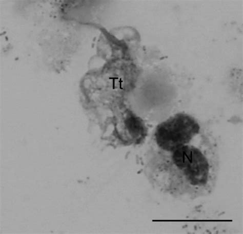 Trichomonas tenax (Tt) and neutrophil (N) in pleural fluid (May-Gr... | Download Scientific Diagram