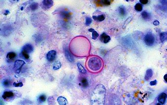 Blastomycosis - symptoms, causes, diagnosis, Blastomycosis treatment