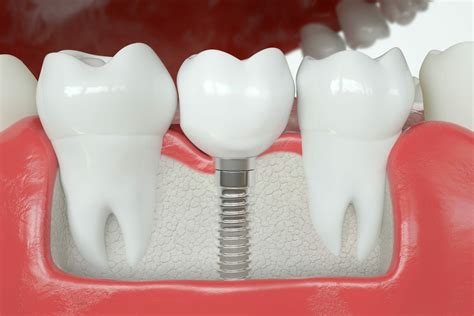 Dental Crown vs Dental Implant - Westerville Dental Associates