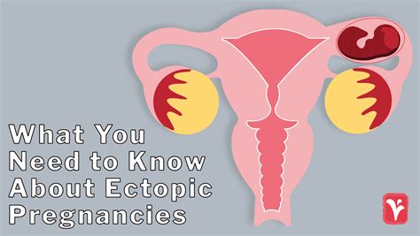 Texas Ectopic Pregnancy Diagnosis & Treatment | Austin Women’s Health