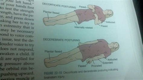 Decorticate and decerebate posturing indicating brainstem injury The Pa ...