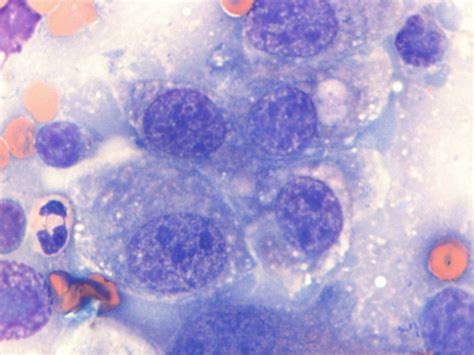 Transitional cell carcinoma (TCC) in a dog | Case Study | Cytopath