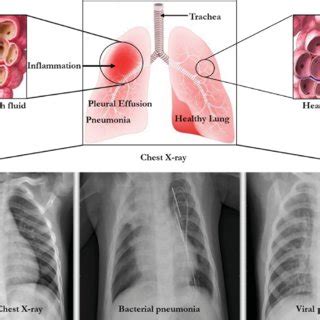 Pathophysiology of pneumonia adopted from flash share at... | Download Scientific Diagram