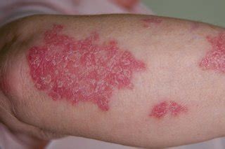 Psoriasis - Symptoms - NHS