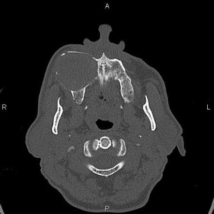 Central Giant Cell Granuloma Radiology Case, 53% OFF