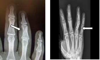 Proximal / Middle phalanx fractures | CUH