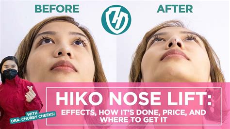 non surgical nose job cost philippines - Mira Engel