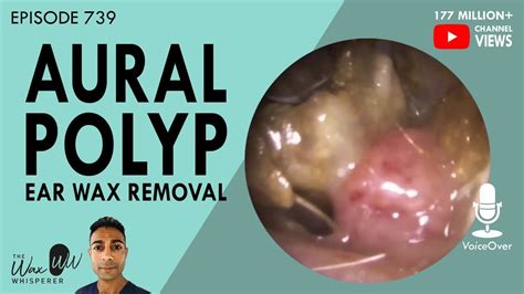 739 - Infected Aural Polyp Ear Wax Removal - YouTube