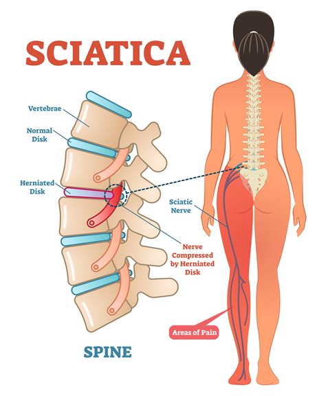 Sciatica Pain Relief - Anatomy & Definition — Revive Sport & Spine