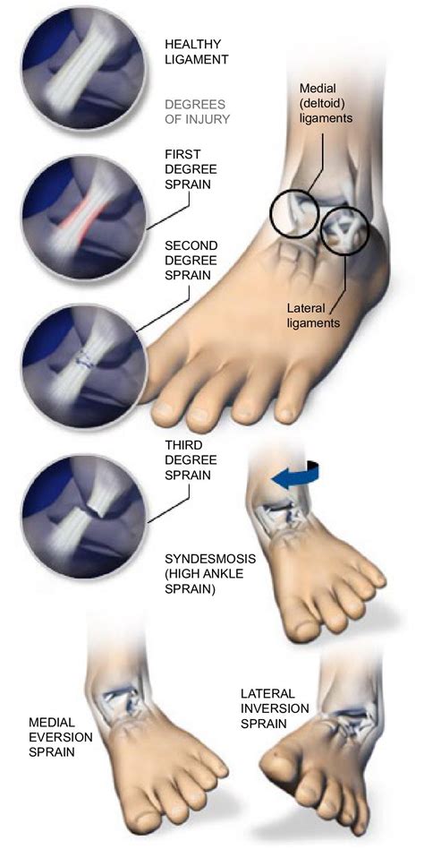 High Ankle Sprain Images