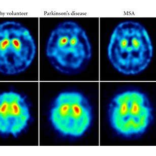 (PDF) Recent Advances in Imaging of Dopaminergic Neurons for Evaluation of Neuropsychiatric ...