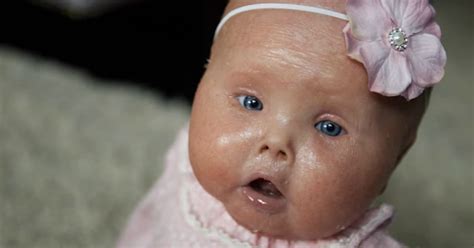 Do Babies with Harlequinn Ichthyosis Survive? Blessed by Brenna Westlake