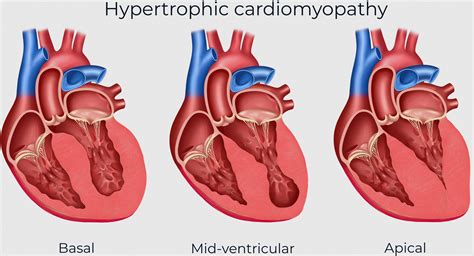 Invasive management of hypertrophic cardiomyopathy with clinically ...