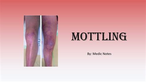 Skin mottling - definition, causes, pathophysiology, sign value - YouTube