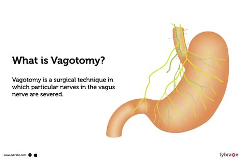 Vagotomy