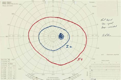 A Normal Goldmann Visual Field, Based on Two Isopters | Download Scientific Diagram