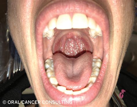 How to perform a head and neck oral/ oropharyngeal cancer screening | Registered Dental ...