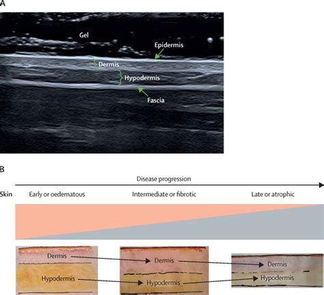 The role of skin ultrasound in systemic sclerosis: looking below the ...