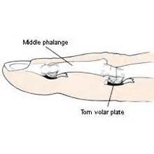 Volar plate injury - Symptoms, Causes & Treatment.