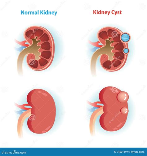 Cyst Stock Image | CartoonDealer.com #89045617