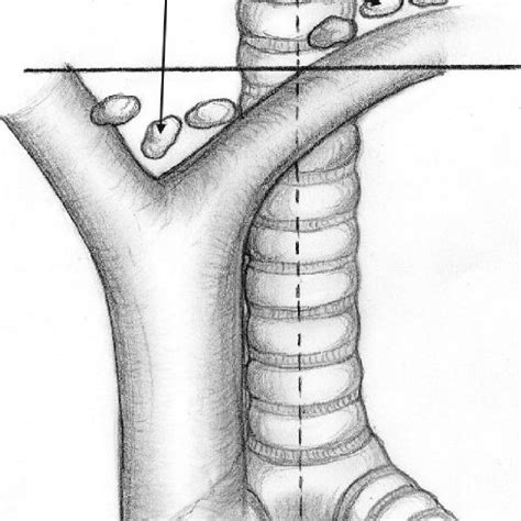 The left innominate vein may run below the upper margin of the aortic arch. | Download ...