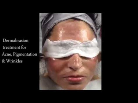 Dermabrasion treatment for acne ,pigmentation and wrinkles - YouTube