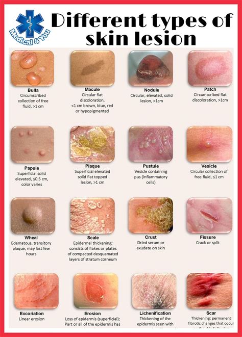 Skin Lesions Types