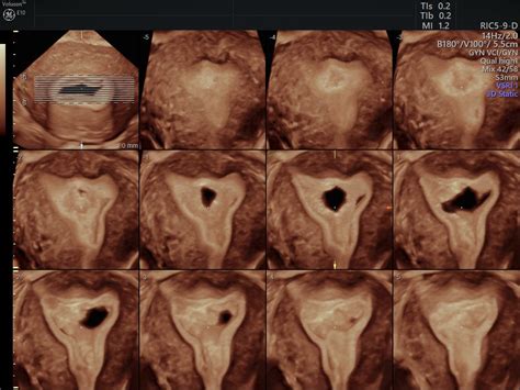 Patients Prefer Transvaginal Ultrasound Over MRI | Empowered Women's Health