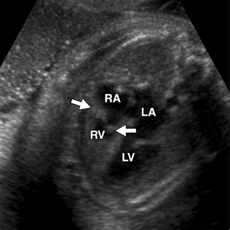 Hypoplastic right heart syndrome causes, symptoms, diagnosis, treatment & prognosis