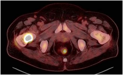 PET-CT scan showing radiotracer uptake of bone metastasis located on... | Download Scientific ...