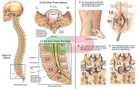 L5-S1 Lumbar Disc Herniation with Surgical Discectomy and Decompression | Doctor Stock