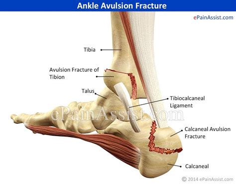 Avulsion Fracture Ankle