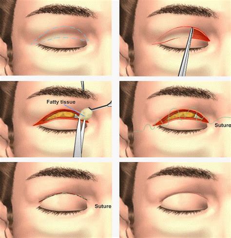 Upper Blepharoplasty Procedure. For the lower eyelids | cosmetic-surgery-mexico | Cosmetic ...