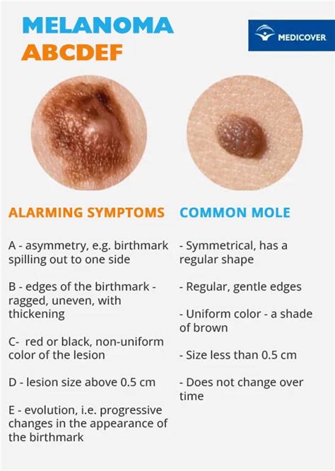 Melanoma - symptoms, causes, treatment and prevention