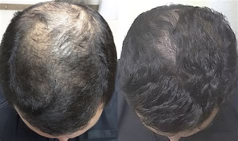 Minoxidil Results After 1 Year - Wimpole Clinic