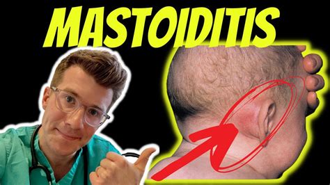 Do you always have a fever with mastoiditis? – Wiki REF