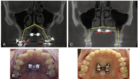 Distraction Osteogenesis Maxillary Expansion (DOME) for Adult Obstructive Sleep Apnea Patients ...