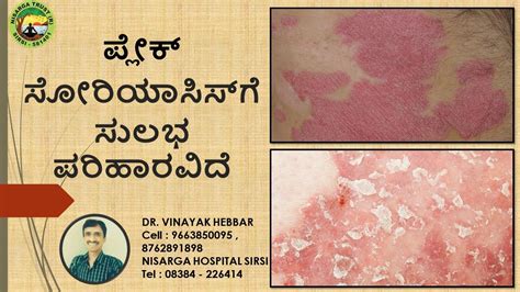 How To Cure Plaque Psoriasis | Home Remedies for Plaque Psoriasis | DR. VINAYAK HEBBAR - YouTube