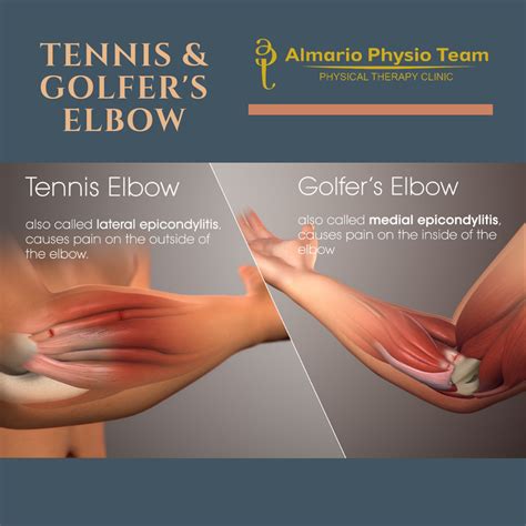 CASECON: Tennis Elbow (Lateral Epicondylitis) & Golfer's Elbow (Medial ...