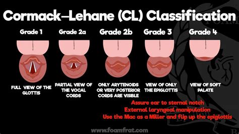 FOAMfrat - Cormack-Lehane (CL) Classification The...