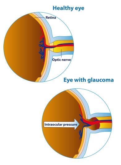 Glaucoma Test · Top Eye Doctors, Specialists in NYC · Optometrist ...