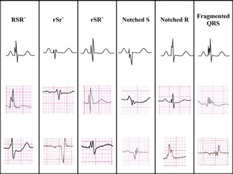 Fragmented QRS: A predictor of mortality and sudden cardiac death ...