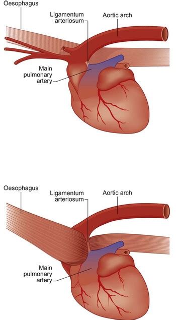 Persistent right aortic arch in a dog | Veterian Key