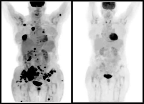 PD-1 Immunotherapy - NewYork-Presbyterian