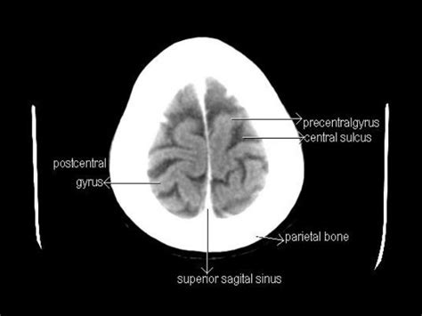 CT Anatomy