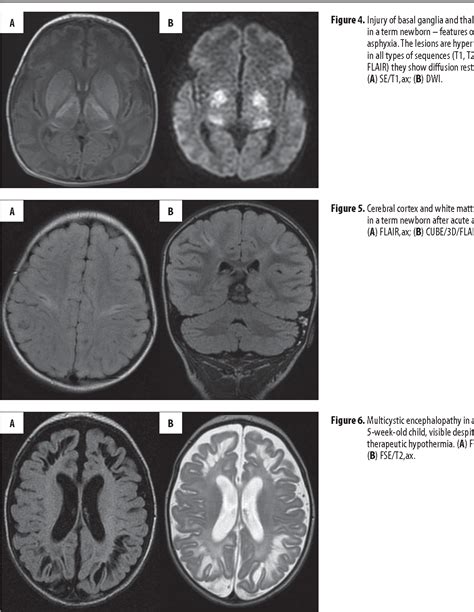 MRI patterns of hypoxic-ischemic brain injury in preterm and full term infants – classical and ...