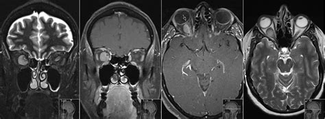 Optic Nerve Sheath Meningioma