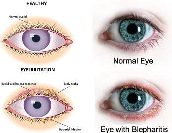 Blepharitis - Golden Eye Optometry