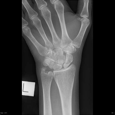 Scaphoid fracture | Image | Radiopaedia.org