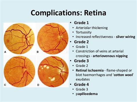 Hypertension complications of the retina : Medical_Students